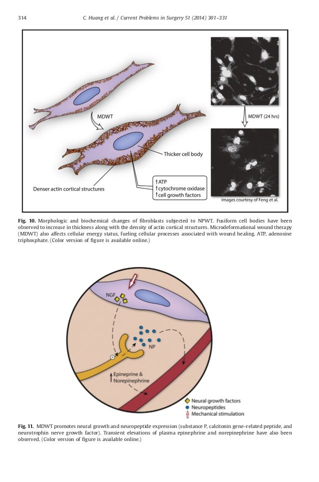 negative pressure wound therapy pdf