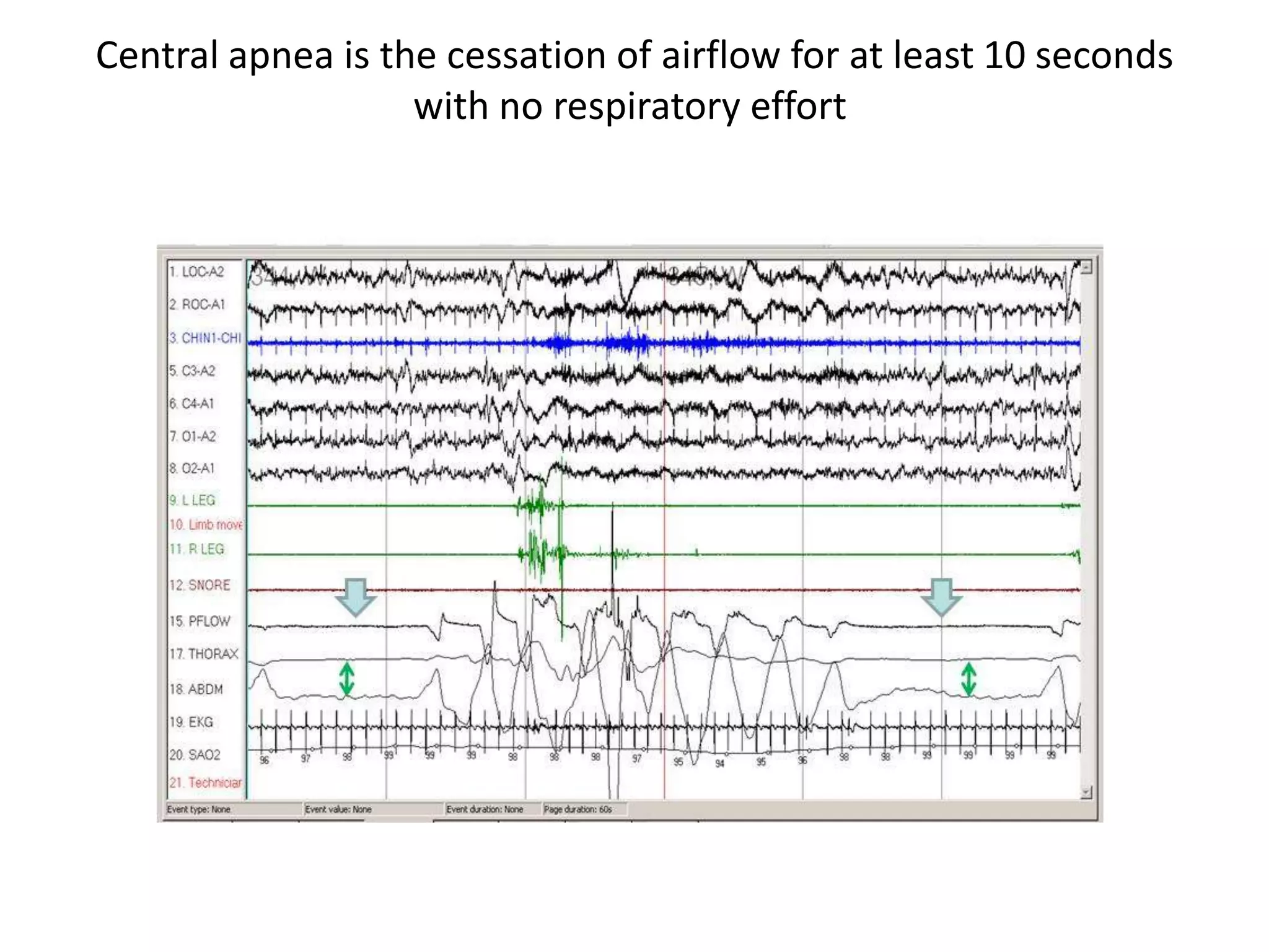Obstructive Sleep Apnea (OSA) | PPTX