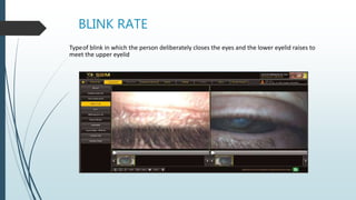 BLINK RATE
Typeof blink in which the person deliberately closes the eyes and the lower eyelid raises to
meet the upper eyelid
 