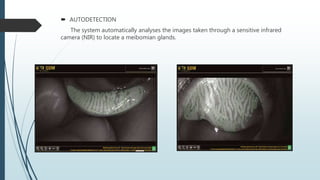  AUTODETECTION
The system automatically analyses the images taken through a sensitive infrared
camera (NIR) to locate a meibomian glands.
 