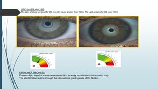 LIPID LAYER ANALYSIS
The Lipid analysis was good for OD eye with values greater than >80nm The Lipid analysis for OS was <30nm
LIPID LAYER THICKNESS
Presents lipid layer thickness measurements in an easy to understand color-coded map.
The identification is done through the international grading scale of Dr. Guillon
 