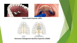 Maxilar Y Rpe OBSTRUCTIVE SLEEP APNEA AND THEIR MANAGEMENT.pptx