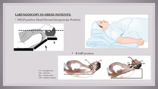 Anesthesia Ramp Position Obstructive sleep apnea anesthetic considerations.pptx