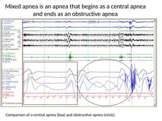 Mixed Apnea Example OBSTRUCTIVE SLEEP APNEA IN OTORHINOLARYNGOLOGY .pptx