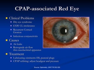 CPAP-associated Red Eye Clinical Problems Dry eye syndrome EXW CL intolerance   Recurrent Corneal  Erosion Infectious conjunctivitis Causes Air leaks Retrograde air flow  thru nasolacrimal apparatus Treatment Lubricating ointments HS, punctal plugs CPAP refitting: adjust headgear and pressure Source: Optometry. 2007;78:352-355 