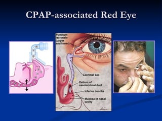 CPAP-associated Red Eye 