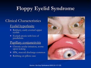 Floppy Eyelid Syndrome Clinical Characteristics Eyelid hyperlaxity Rubbery, easily everted upper eyelids Eyelash ptosis with loss of parallelism Papillary conjunctivitis Chronic ocular irritation, worse upon waking  SPK, mucoid discharge common Rubbing on pillow case Source: Clin Exp Ophthalmol 2005;33:117-125. 