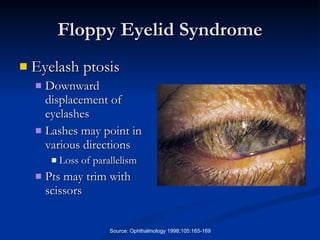 Floppy Eyelid Syndrome Eyelash ptosis Downward displacement of eyelashes Lashes may point in various directions  Loss of parallelism Pts may trim with scissors Source: Ophthalmology 1998;105:165-169 