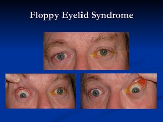 Floppy Eyelid Syndrome 