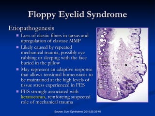 Floppy Eyelid Syndrome Etiopathogenesis Loss of elastic fibers in tarsus and upregulation of elastase MMP Likely caused by repeated mechanical trauma, possibly eye rubbing or sleeping with the face buried in the pillow May represent an adaptive response that allows tensional homeostasis to be maintained at the high levels of tissue stress experienced in FES FES strongly associated with  keratoconus , reinforcing suspected role of mechanical trauma Source: Surv Ophthalmol 2010;55:35-46 