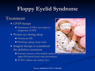 Floppy Eyelid Syndrome Treatment CPAP therapy Treatment of OSA can improve  symptoms of FES Protect eye during sleep Ointments HS Patching, taping, sleep mask Surgical therapy is considered  the definitive treatment Greatest success with medial canthus/lateral canthus plication and upper lid lateral tarsal strip procedures 25-50% failure rate within 2yrs Source: Ophthalmol. 2010;117:839-846 