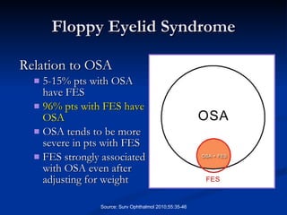 Floppy Eyelid Syndrome Relation to OSA 5-15% pts with OSA have FES 96% pts with FES have OSA   OSA tends to be more severe in pts with FES FES strongly associated with OSA even after adjusting for weight Source: Surv Ophthalmol 2010;55:35-46 