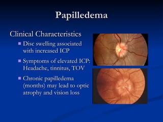 Papilledema Clinical Characteristics Disc swelling associated with increased ICP Symptoms of elevated ICP: Headache, tinnitus, TOV  Chronic papilledema (months) may lead to optic atrophy and vision loss  