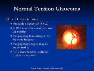 Normal Tension Glaucoma Clinical Characteristics Probably a variant of POAG IOP is never documented above 21 mmHg  Peripapillary hemorrhages may be more frequent Peripapillary atrophy may be more marked  VF defects tend to be deeper and more localized  Source: Shield's Textbook of Glaucoma, 2005 