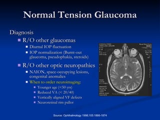 Normal Tension Glaucoma Diagnosis R/O other glaucomas Diurnal IOP fluctuation IOP normalization (Burnt-out glaucoma, pseudophakia, steroids) R/O other optic neuropathies NAION, space-occupying lesions, congenital anomalies When to order neuroimaging :  Younger age (<50 yrs) Reduced VA (< 20/40) Vertically aligned VF defects Neuroretinal rim pallor Source: Ophthalmology 1998;105:1866-1874 