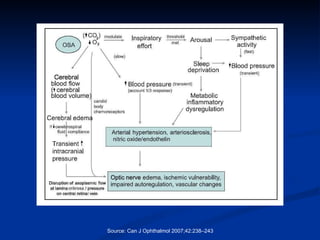 Source: Can J Ophthalmol 2007;42:238–243 