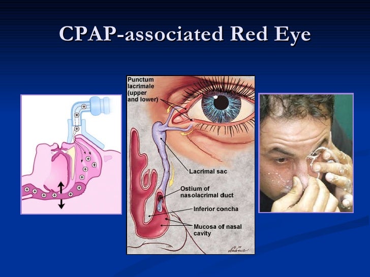 Sleep Apnea & The Eye 2011