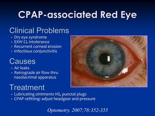 CPAP-associated Red Eye
Clinical Problems
•   Dry eye syndrome
•   EXW CL intolerance
•   Recurrent corneal erosion
•   Infectious conjunctivitis

Causes
•   Air leaks
•   Retrograde air flow thru
    nasolacrimal apparatus

Treatment
•   Lubricating ointments HS, punctal plugs
•   CPAP refitting: adjust headgear and pressure

                      Optometry. 2007;78:352-355
 