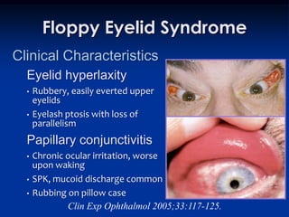 Floppy Eyelid Syndrome
Clinical Characteristics
  Eyelid hyperlaxity
  •   Rubbery, easily everted upper
      eyelids
  •   Eyelash ptosis with loss of
      parallelism
  Papillary conjunctivitis
  •   Chronic ocular irritation, worse
      upon waking
  •   SPK, mucoid discharge common
  •   Rubbing on pillow case
              Clin Exp Ophthalmol 2005;33:117-125.
 