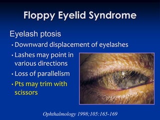 Floppy Eyelid Syndrome
Eyelash ptosis
• Downward displacement       of eyelashes
• Lashes may  point in
  various directions
• Loss of parallelism

• Pts may trim with
  scissors

           Ophthalmology 1998;105:165-169
 