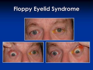 Floppy Eyelid Syndrome
 