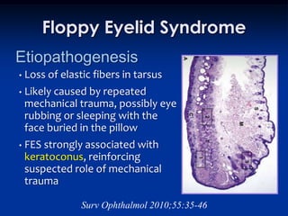 Floppy Eyelid Syndrome
Etiopathogenesis
•   Loss of elastic fibers in tarsus
•   Likely caused by repeated
    mechanical trauma, possibly eye
    rubbing or sleeping with the
    face buried in the pillow
•   FES strongly associated with
    keratoconus, reinforcing
    suspected role of mechanical
    trauma

                 Surv Ophthalmol 2010;55:35-46
 