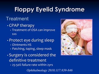 Floppy Eyelid Syndrome
Treatment
• CPAP     therapy
 •   Treatment of OSA can improve
     sxs

• Protect eye      during sleep
 •   Ointments HS
 •   Patching, taping, sleep mask

• Surgery isconsidered the
 definitive treatment
 •   25-50% failure rate within 2yrs
                Ophthalmology 2010;117:839-846
 