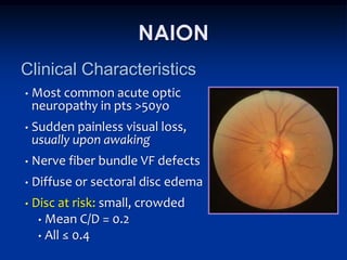 NAION
Clinical Characteristics
•   Most common acute optic
    neuropathy in pts >50yo
•   Sudden painless visual loss,
    usually upon awaking
•   Nerve fiber bundle VF defects
•   Diffuse or sectoral disc edema
•   Disc at risk: small, crowded
     • Mean C/D = 0.2
     • All ≤ 0.4
 