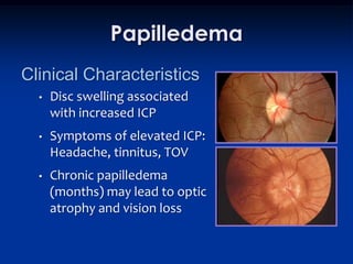Papilledema
Clinical Characteristics
  •   Disc swelling associated
      with increased ICP
  •   Symptoms of elevated ICP:
      Headache, tinnitus, TOV
  •   Chronic papilledema
      (months) may lead to optic
      atrophy and vision loss
 