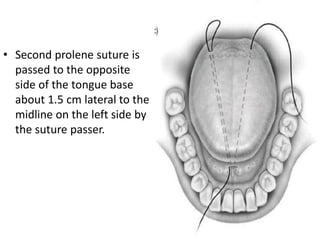 • Second prolene suture is
passed to the opposite
side of the tongue base
about 1.5 cm lateral to the
midline on the left side by
the suture passer.
 