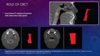ROLE OF CBCT
• Cone-beam CT analysis of patients
with obstructive sleep apnea
Cone-beam CT analysis of patients with obstructive sleep apnea compared to normal controls Allison Buchanan, Ruben Cohen, Stephen Looney3,,
Sajitha Kalathingal, Scott De Rossi; Imaging Science in Dentistry 2016; 46: 9-16
 