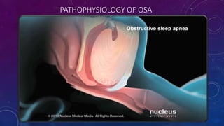 PATHOPHYSIOLOGY OF OSA
 