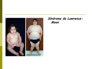 Síndrome de Lawrence-
Moon
 