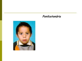 Fenilcetonúria
 