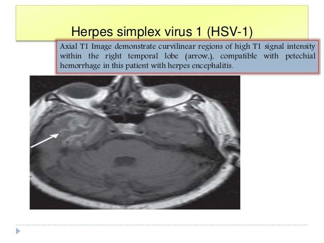 Imaging Of Viral Encephalitis