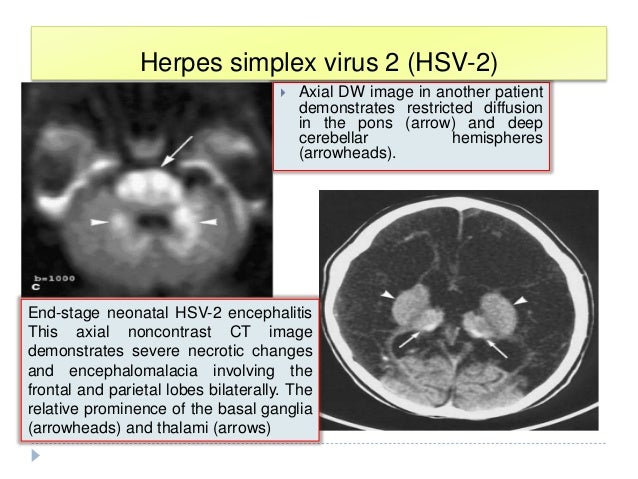 Imaging Of Viral Encephalitis