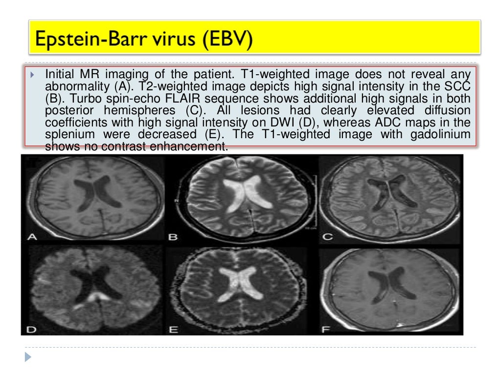 imaging of viral encephalitis