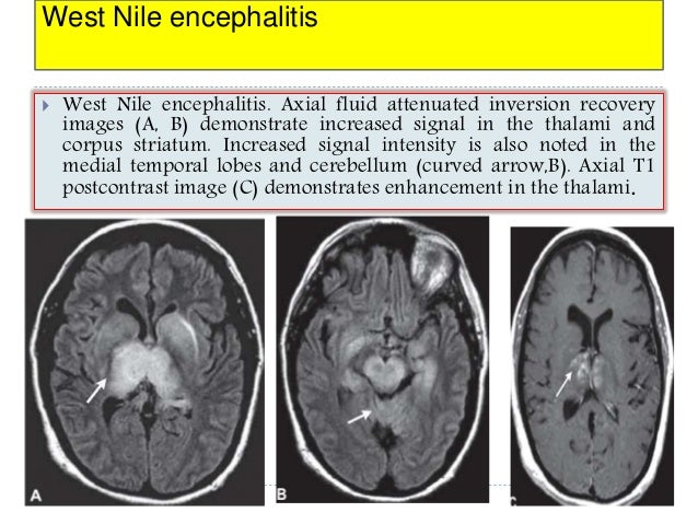 imaging of viral encephalitis