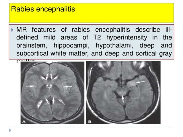 imaging of viral encephalitis