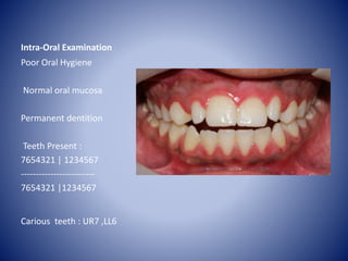 Intra-Oral Examination
Poor Oral Hygiene
Normal oral mucosa
Permanent dentition
Teeth Present :
7654321 | 1234567
-------------------------
7654321 |1234567
Carious teeth : UR7 ,LL6
 