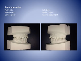 Anteroposterior:
Right side
Molar Class I
Canine Class I
Left Side
Molar Class I
Canine Class III 1/4
 