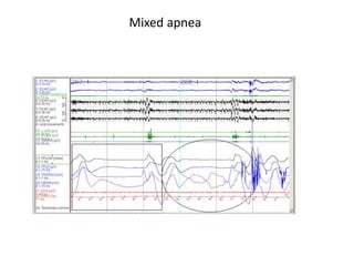 Mixed apnea
 