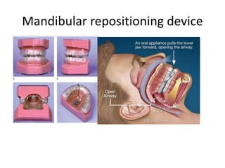 Mandibular repositioning device
 