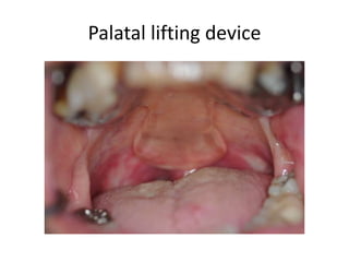 Palatal lifting device
 