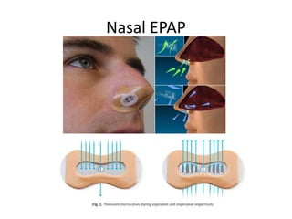 Nasal EPAP
 