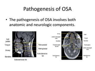 Pathogenesis of OSA
• The pathogenesis of OSA involves both
anatomic and neurologic components.
 