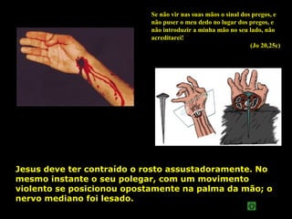 Se não vir nas suas mãos o sinal dos pregos, e
não puser o meu dedo no lugar dos pregos, e
não introduzir a minha mão no seu lado, não
acreditarei!
(Jo 20,25c)

Jesus deve ter contraído o rosto assustadoramente. No
mesmo instante o seu polegar, com um movimento
violento se posicionou opostamente na palma da mão; o
nervo mediano foi lesado.

 