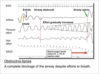 OSA overview Power Point Sleep Fellowship | PDF