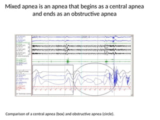 Comprehensive Overview of Obstructive Sleep Apnea: Physiology ...