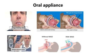 Oral appliance
 